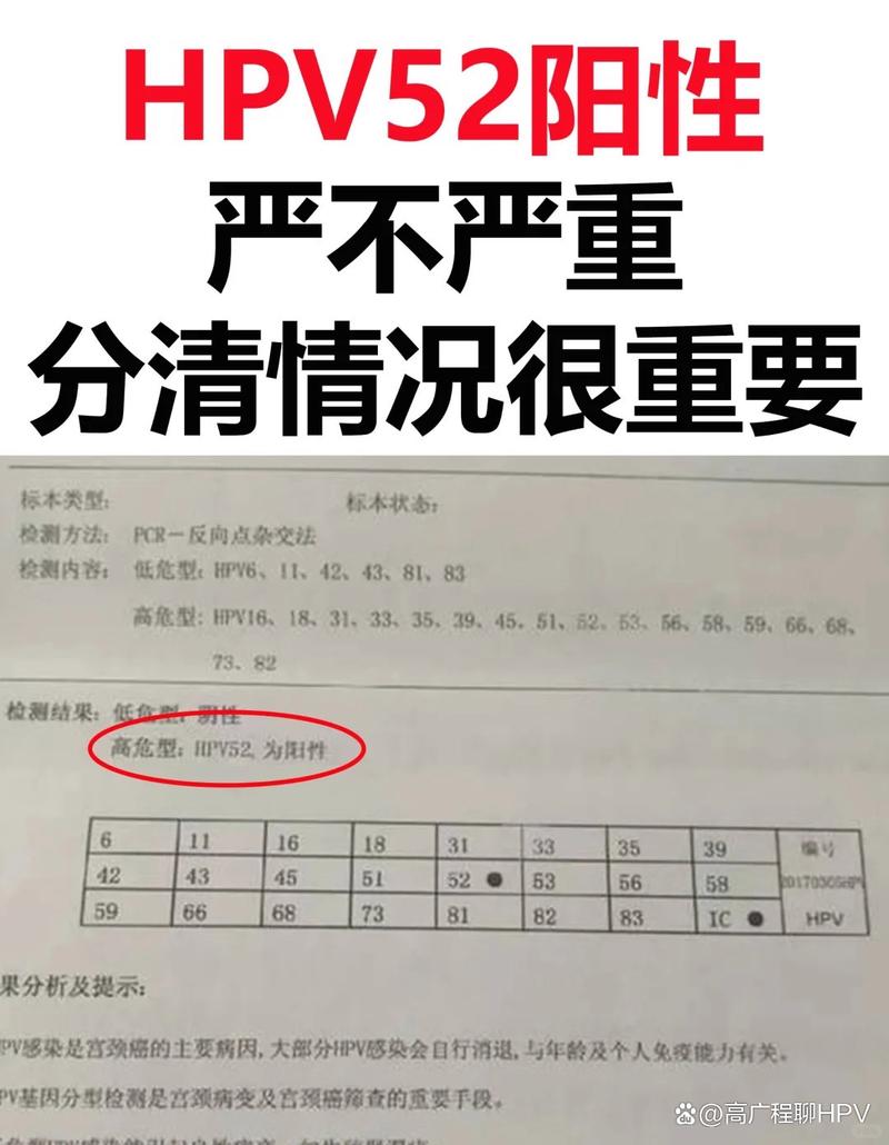 hpv52阳性是怎么感染的？hpv病毒52型阳性严重吗？-第7张图片-优品飞百科