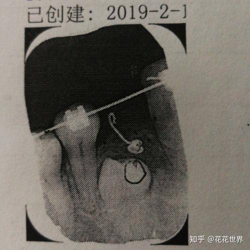 疫情手术过程，疫情手术视频-第6张图片-优品飞百科