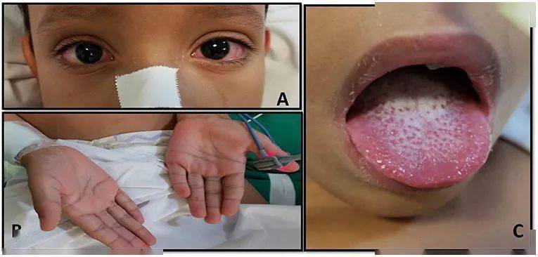 孩子疫情表现？儿童疫情表现？-第6张图片-优品飞百科