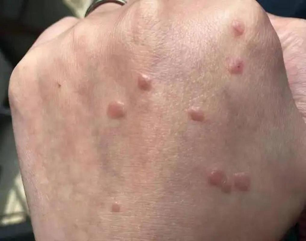 hpv感染症状男性会有什么症状，hpv感染症状男性会有什么症状图片？