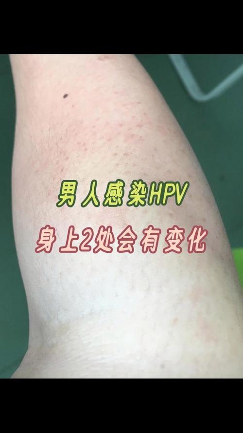 hpv感染症状男性会有什么症状，hpv感染症状男性会有什么症状图片？-第3张图片-优品飞百科