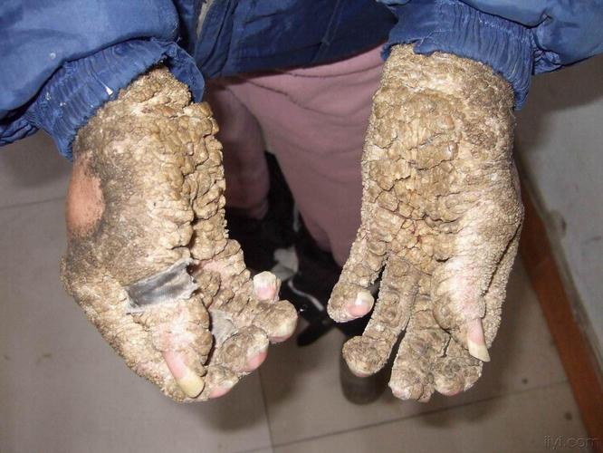 hpv感染症状男性会有什么症状，hpv感染症状男性会有什么症状图片？-第4张图片-优品飞百科