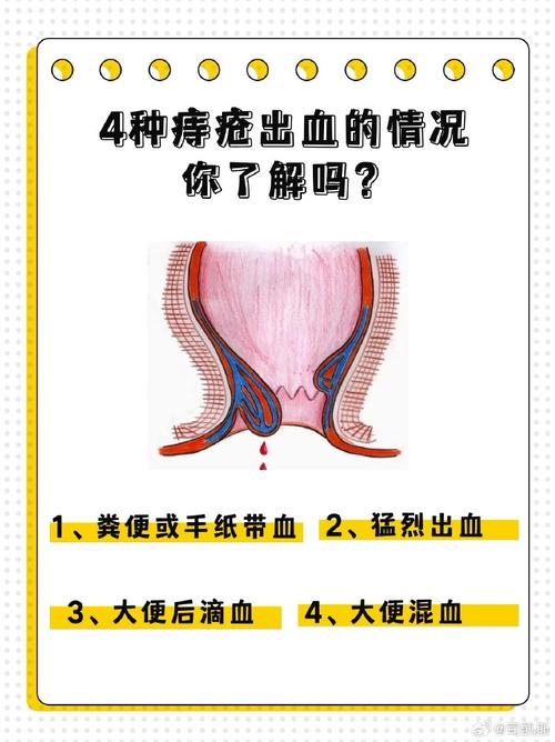 关于疫情期间肛裂的信息-第6张图片-优品飞百科 关于疫情期间肛裂的信息-第6张图片-优品飞百科
