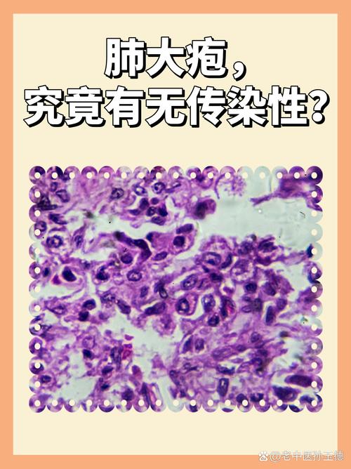 肺炎疫情的肺，疫情肺炎的简单介绍-第4张图片-优品飞百科