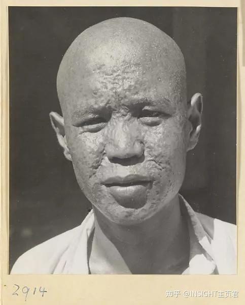 天花大疫情，天花疫情最新消息？-第2张图片-优品飞百科