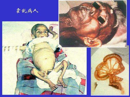 发霍乱疫情？霍乱疫情报告？-第5张图片-优品飞百科