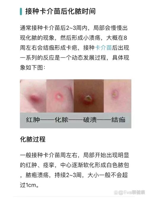 卡介苗疫情，卡介苗疫苗费用？-第2张图片-优品飞百科