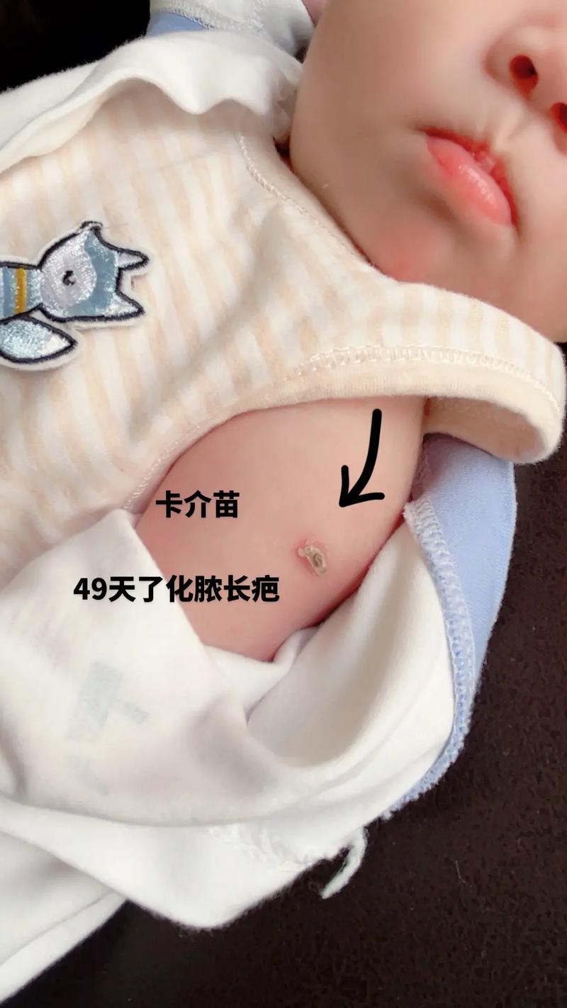 卡介苗疫情，卡介苗疫苗费用？-第3张图片-优品飞百科