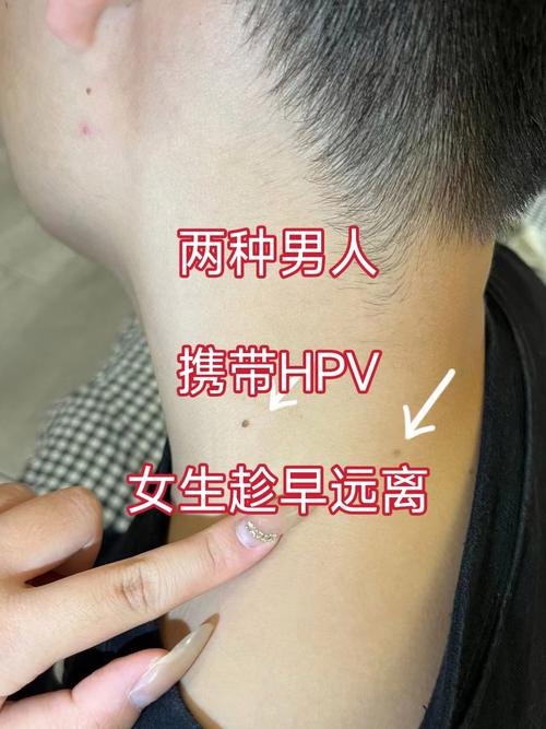 hpv男性有什么症状，hpv男性有什么症状颈部有疣？-第3张图片-优品飞百科