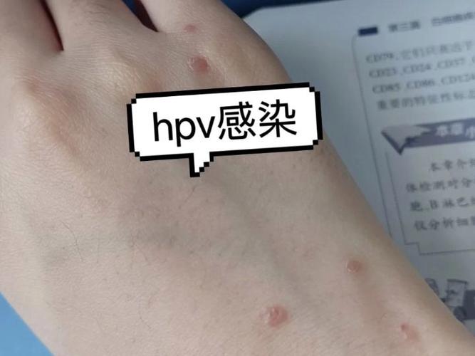 hpv男性有什么症状，hpv男性有什么症状颈部有疣？-第4张图片-优品飞百科