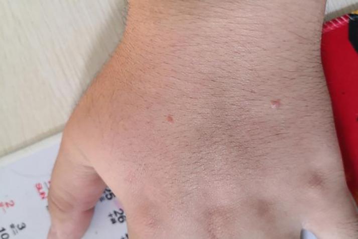 hpv男性有什么症状，hpv男性有什么症状颈部有疣？-第7张图片-优品飞百科