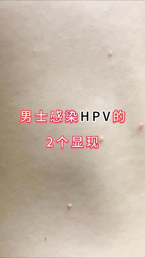 hpv男性有什么症状，hpv男性有什么症状颈部有疣？-第8张图片-优品飞百科