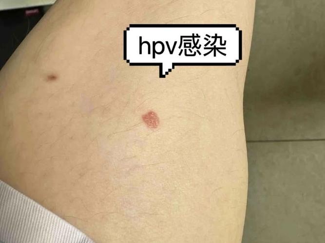 hpv是什么病男性，hpv是什么病怎么得的男性-第1张图片-优品飞百科