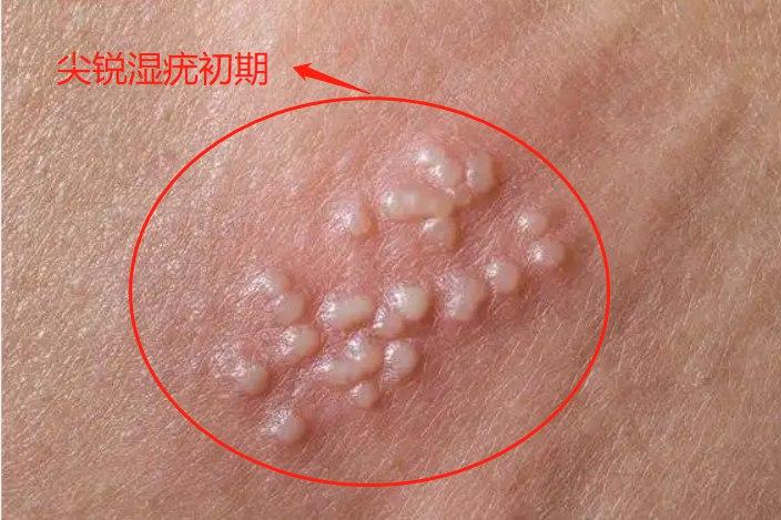 hpv是什么病男性，hpv是什么病怎么得的男性-第3张图片-优品飞百科