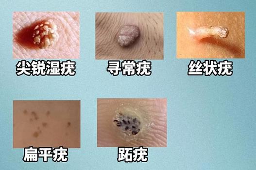 hpv是什么病男性，hpv是什么病怎么得的男性-第4张图片-优品飞百科