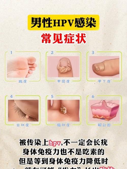 hpv是什么病男性，hpv是什么病怎么得的男性-第5张图片-优品飞百科