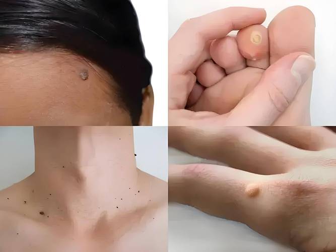 hpv是什么病男性，hpv是什么病怎么得的男性-第6张图片-优品飞百科