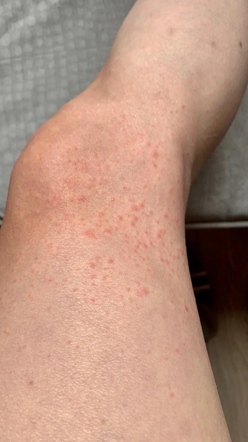 疫情爆发症状？疫情爆发症状有哪些？-第3张图片-优品飞百科