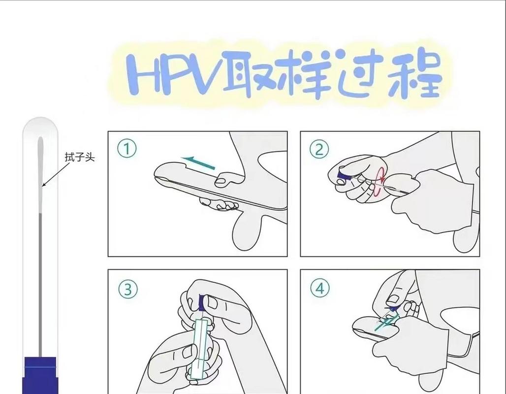 男性hpv怎么检查，男性HPV怎么检查治疗？-第5张图片-优品飞百科